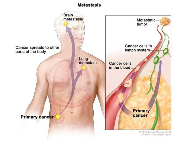 St. Stamford Modern Cancer Hospital Guangzhou, advanced cancer,Metastatic Cancer, Bone Metastasis 