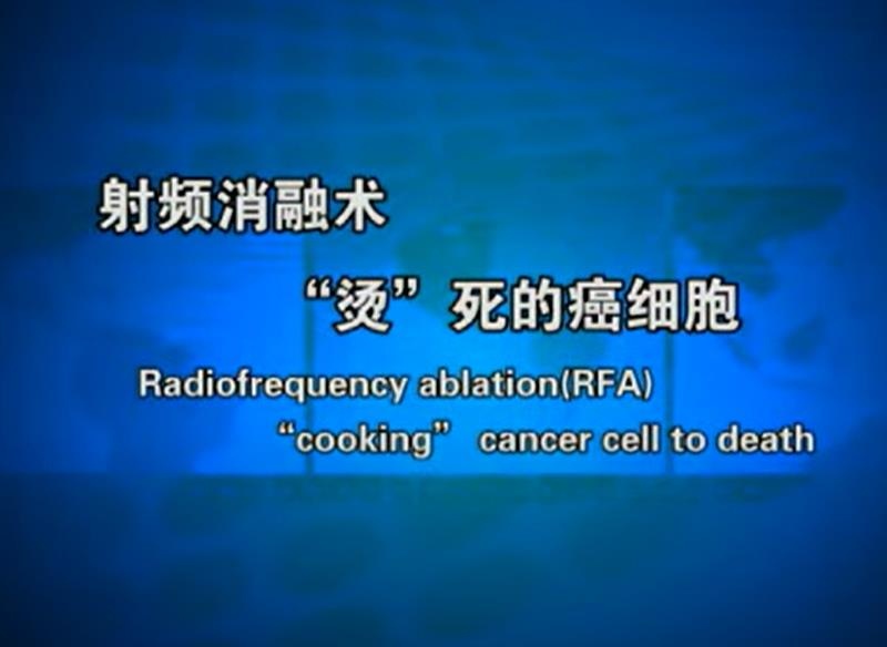 Radiofrequency ablation “cooking” cancer cell to death