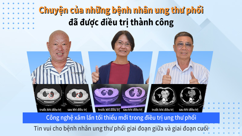 Công nghệ điều trị ung thư phổi xâm lấn tối thiếu - Không cần phẫu thuật lồ