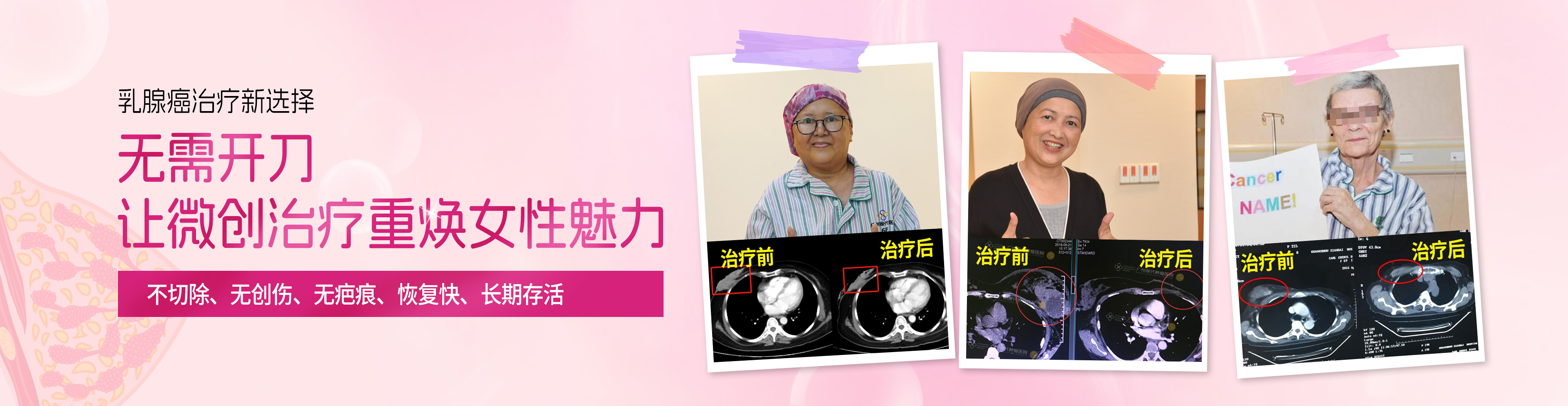乳腺癌治疗新选择：无需开刀，让微创治疗重焕女性魅力；不切除、无创伤、无疤痕、恢复快、长期存活