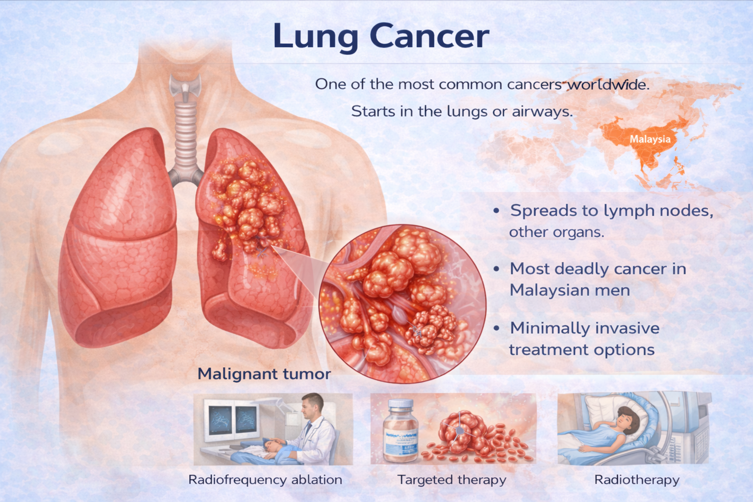 Lung Cancer Lung Cancer