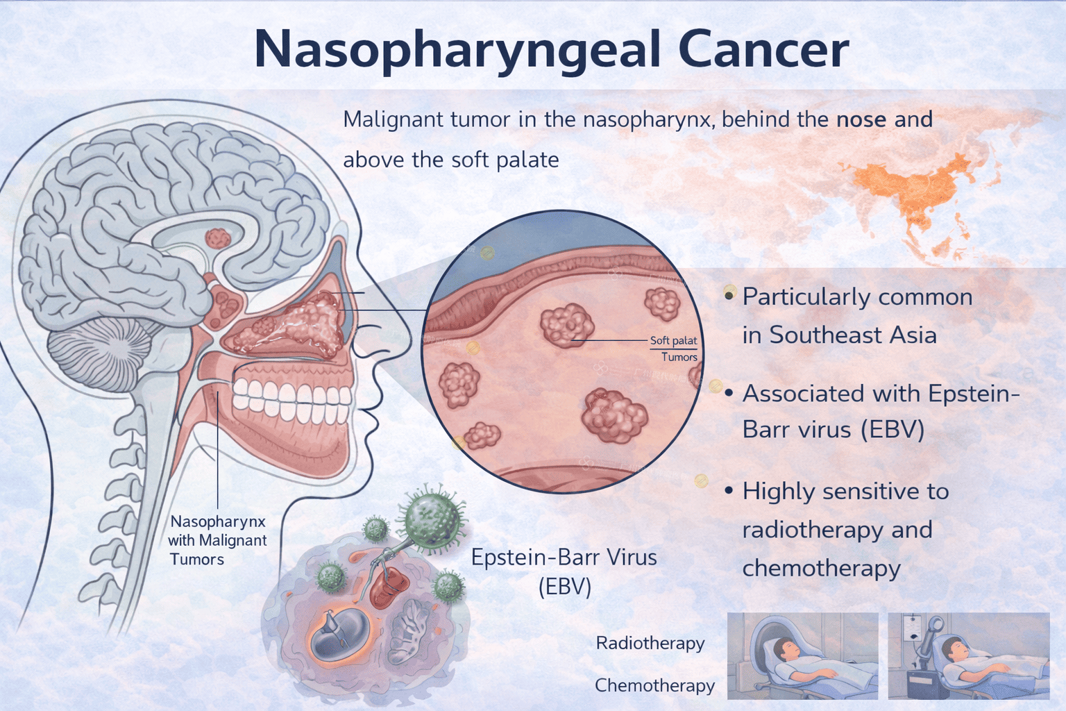 Nasopharyngeal Cancer Nasopharyngeal Cancer