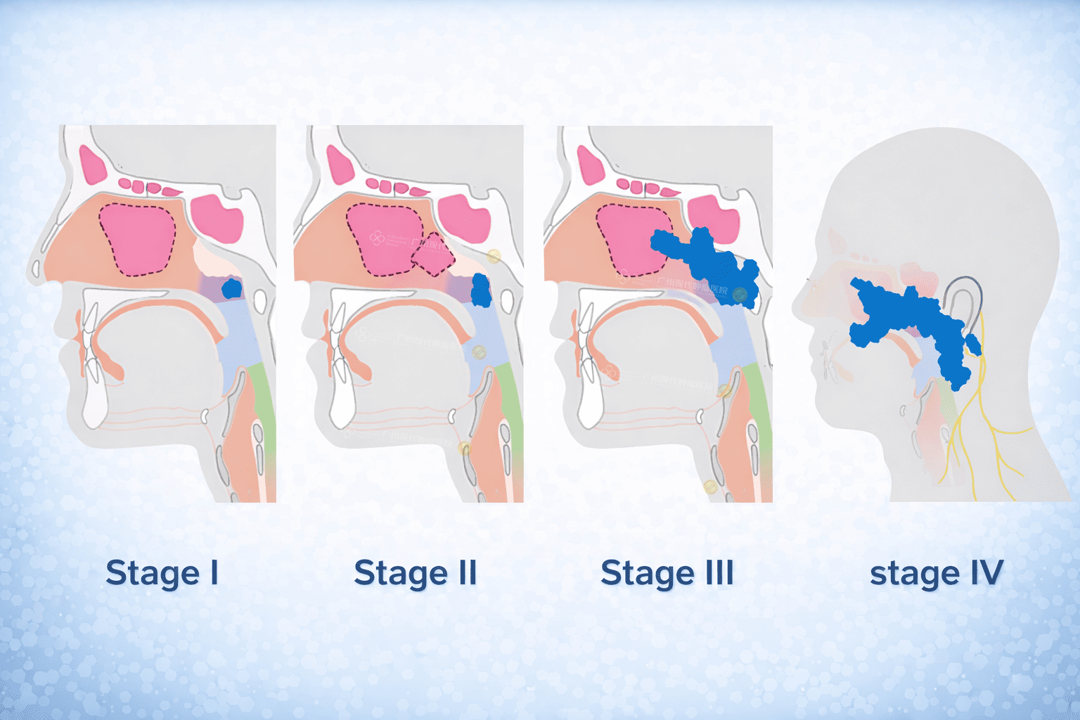 Stage of Nasopharyngeal Cancer Stage of Nasopharyngeal Cancer
