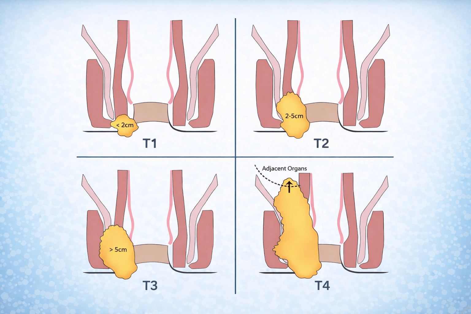 肛门癌,肛门癌治疗,癌症治疗,肛门癌治疗技术,肛门癌症状,肛门癌风险因素,肛门癌分期,肛门癌类型,中晚期肛门癌,肛门癌诊断,微创技术,广州现代肿瘤医院 肛门癌,肛门癌治疗,癌症治疗,肛门癌治疗技术,肛门癌症状,肛门癌风险因素,肛门癌分期,肛门癌类型,中晚期肛门癌,肛门癌诊断,微创技术,广州现代肿瘤医院