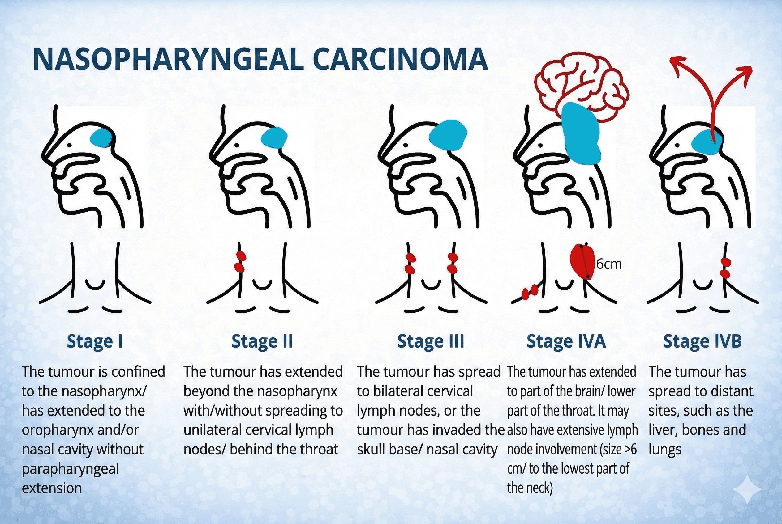 鼻咽癌,鼻咽癌治疗,癌症治疗,鼻咽癌治疗技术,鼻咽癌症状,鼻咽癌风险因素,鼻咽癌分期,鼻咽癌类型,中晚期鼻咽癌,鼻咽癌诊断,微创技术,广州现代肿瘤医院 鼻咽癌,鼻咽癌治疗,癌症治疗,鼻咽癌治疗技术,鼻咽癌症状,鼻咽癌风险因素,鼻咽癌分期,鼻咽癌类型,中晚期鼻咽癌,鼻咽癌诊断,微创技术,广州现代肿瘤医院