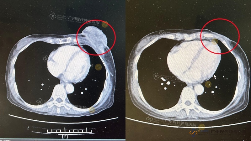 Juli 2024, Mayette telah menjalani total 1x Microwave Ablation dan 6x Intervensi