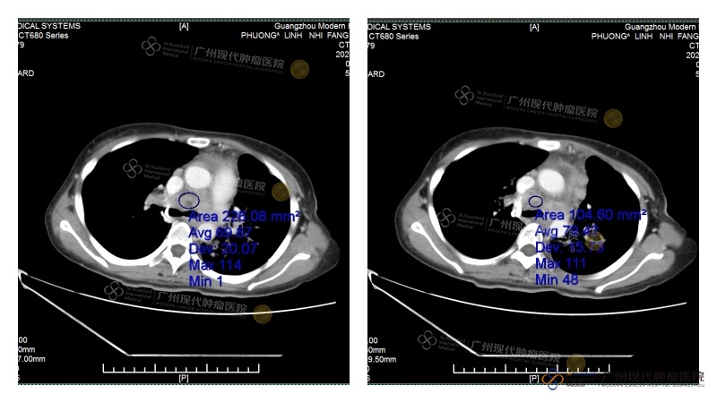 Tumor paru mengecil sekitar 60%