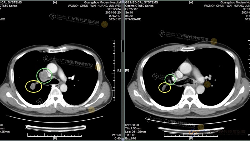 Saat pertama kali masuk RS tahun 2024 VS pemeriksaan ulang ketiga: Lesi tumor mengecil secara signifikan