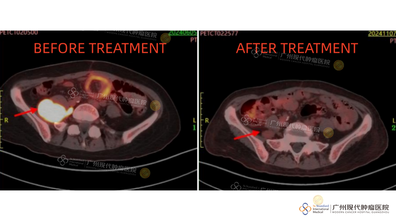 Perbandingan Pengobatan Tumor Retroperitoneal