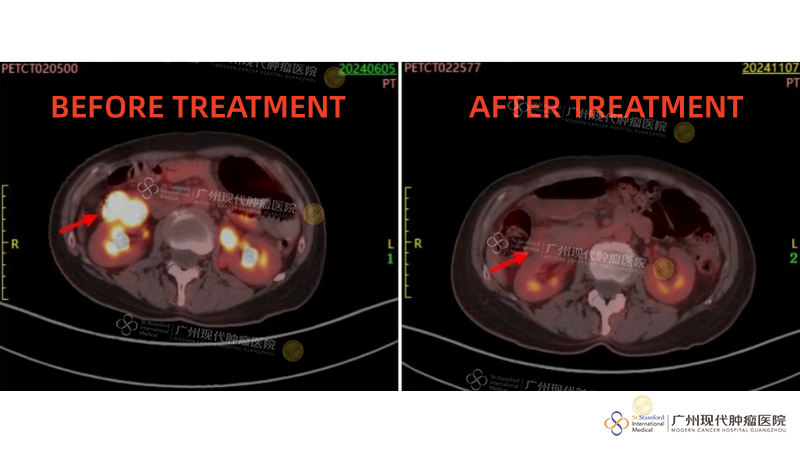 Perbandingan Pengobatan Tumor Abdomen dan Panggul