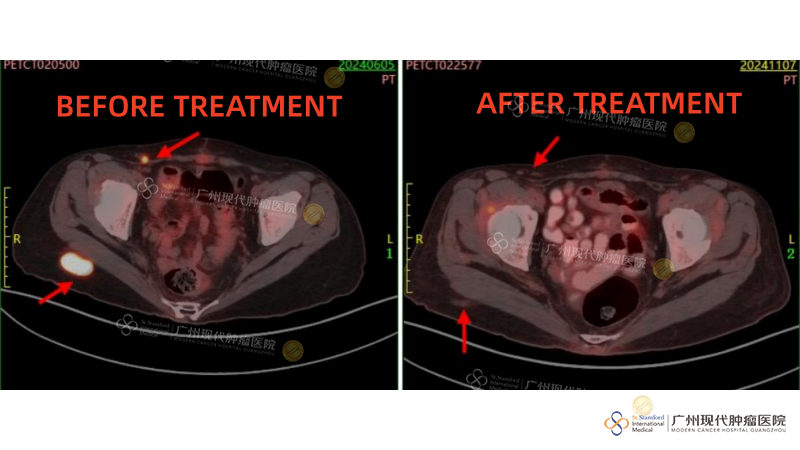 Perbandingan Pengobatan Tumor Panggul