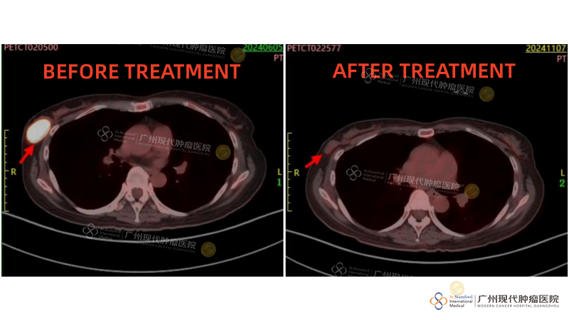 Perbandingan Pengobatan Tumor Dinding Dada Kanan