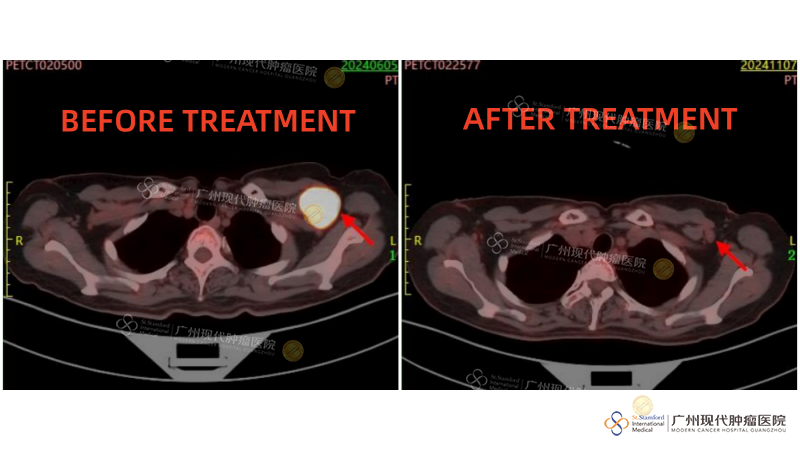 Perbandingan Pengobatan Tumor Ketiak Kiri